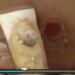 Removed Skin Cancer Tumor With Black Salve (long version)