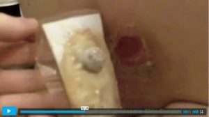 Removed Skin Cancer Tumor With Black Salve (long version)